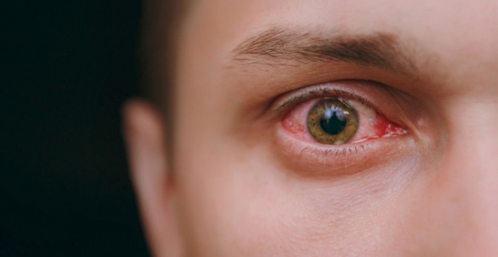 Göz enfeksiyonuna ne iyi gelir?
