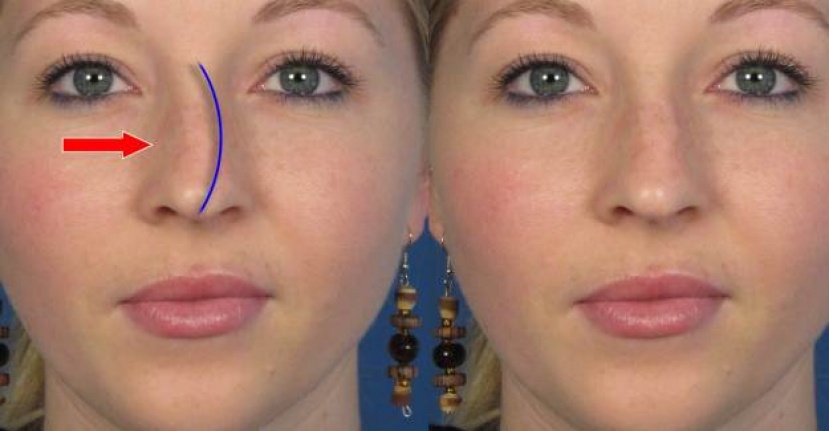Burun kemik eğriliği (septum deviasyonu) nedir?
