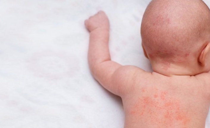 Çocuklarda besin alerjisi neden artıyor?