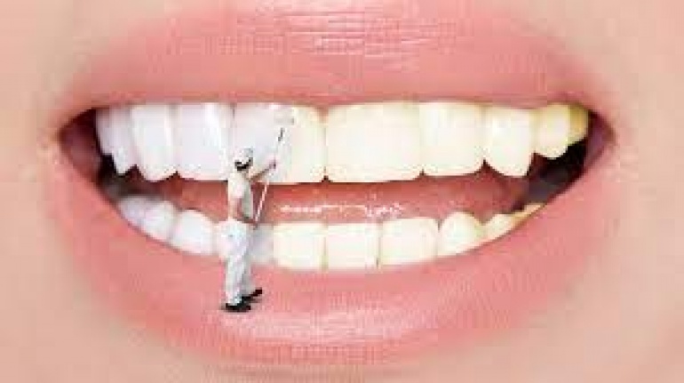 Diş beyazlatmada portakal kabuğu etkisi