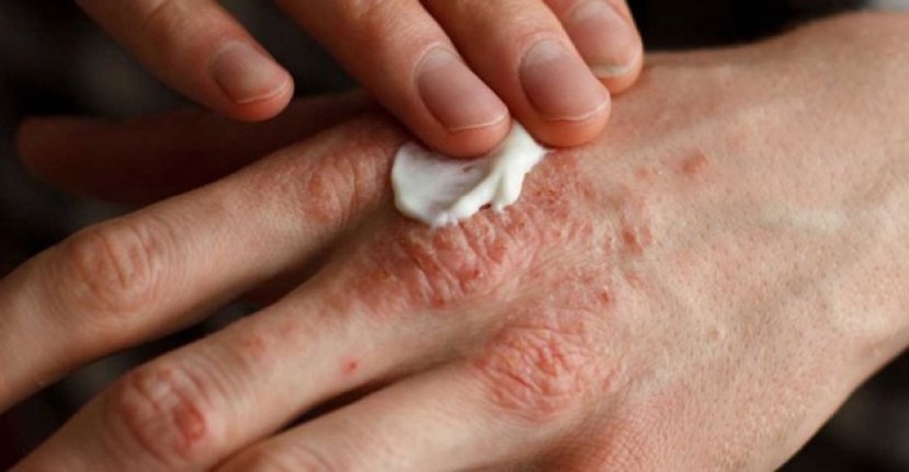 El dezenfektanları cilde zarar veriyor