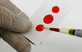 Hepatit b taşıyan insanların %80'i taşıdığını bilmiyor