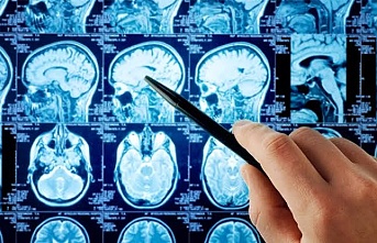 Nöroloji bölümü hangi hastalıklara bakar?
