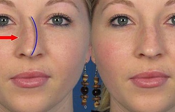 Burun kemik eğriliği (septum deviasyonu) nedir?