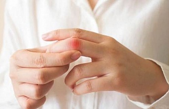 Lupus hastalığının bitkisel tedavi yöntemleri