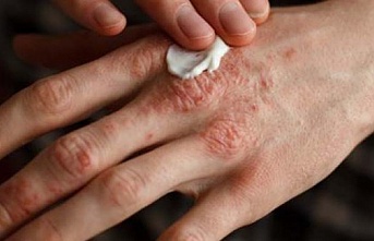 Sedef hastalığı psoriasis nedir?