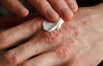 El dezenfektanları cilde zarar veriyor