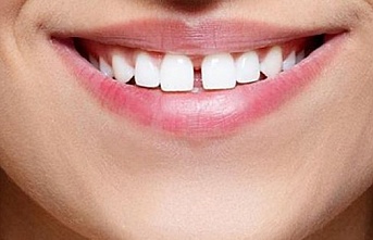 Zirkonyum ile ayrık dişlere veda edin