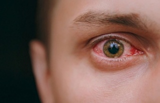 Göz enfeksiyonuna ne iyi gelir?