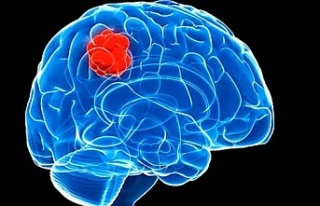 Bu belirtiler beyin tümörünün habercisi