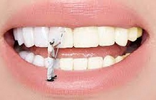 Diş beyazlatmada portakal kabuğu etkisi