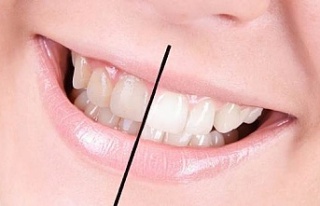 Dişlerin beyazlaması için öneriler