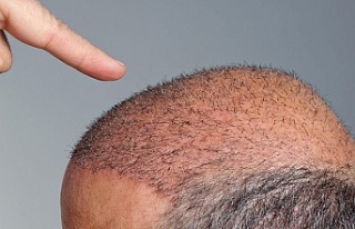 Saç ektirmenin zararlarını biliyor musunuz?